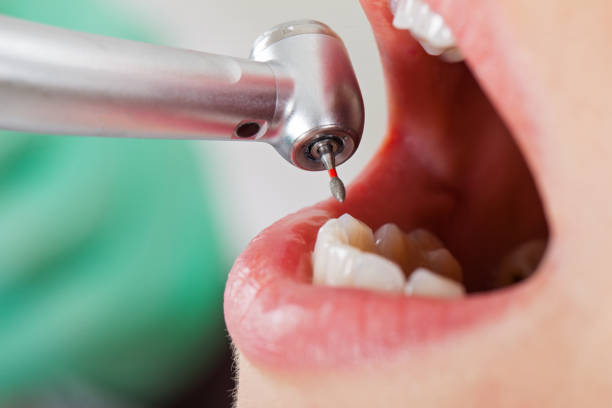 Best Emergency Broken Tooth Repair in Diamond Springs, CA